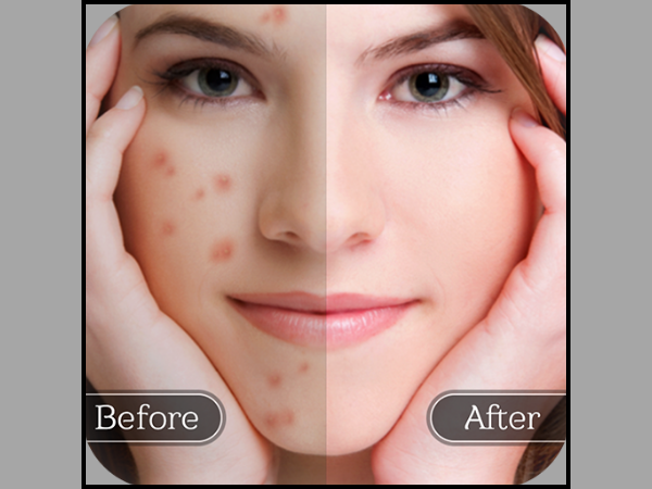 app xóa mụn cho iphone