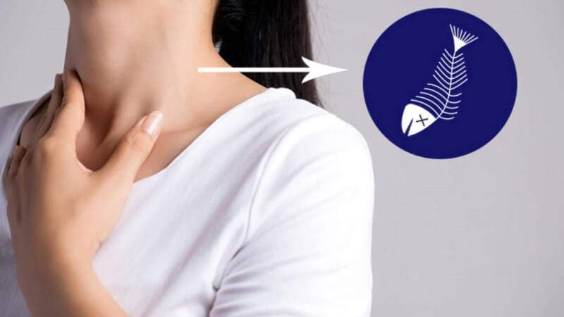 Các biểu hiện ngay sau khi bị hóc xương cá phổ biến