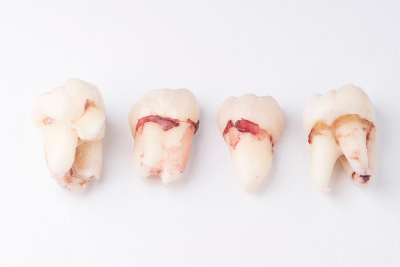 Giấc mơ rụng bốn chiếc răng thường được xem là lời nhắc chú ý đến những thay đổi lớn và cách phân bổ nguồn lực cá nhân